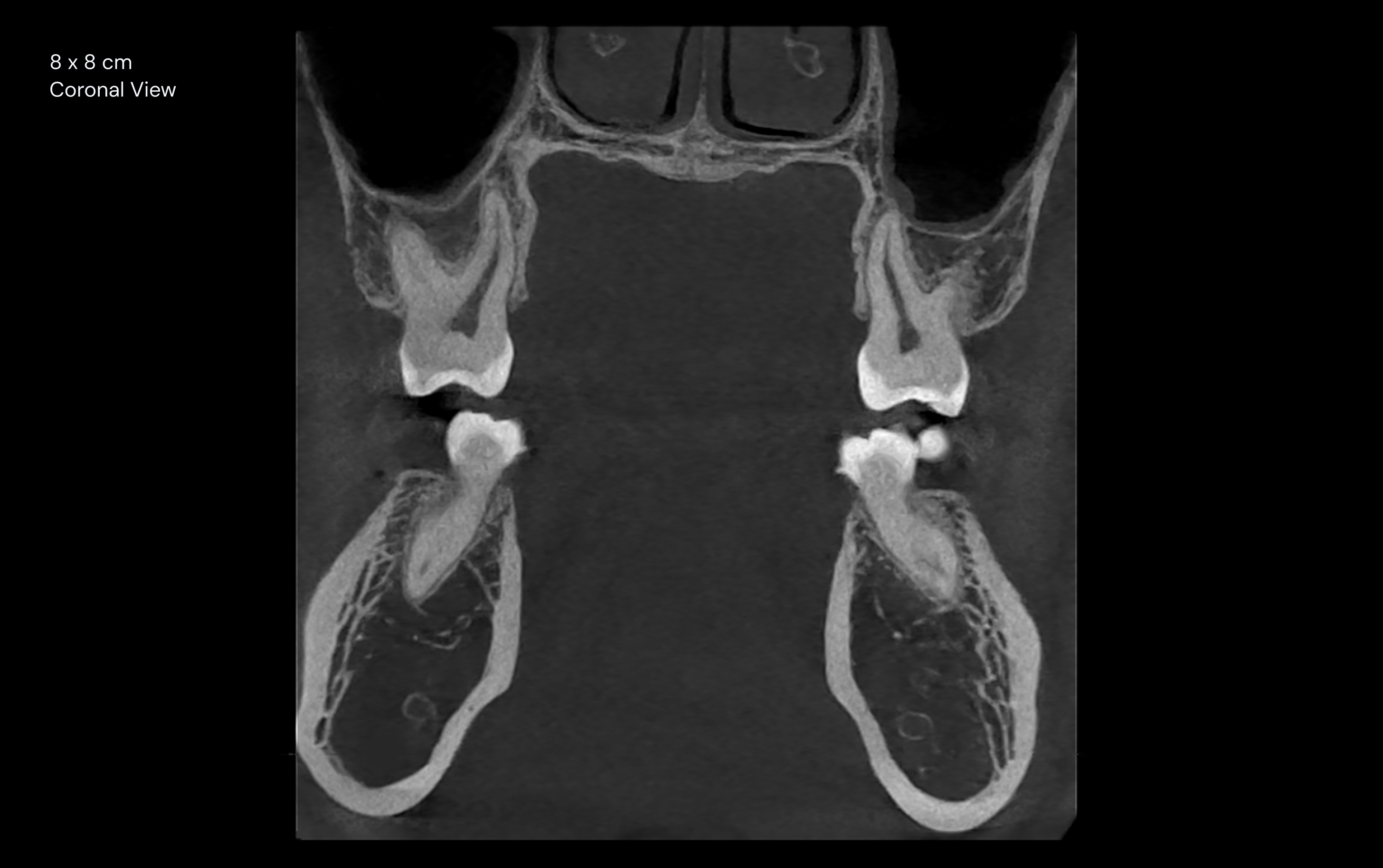 8 x 8 cm Coronal View